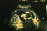 <em>Amnesty International</em> aicina mainīt Īrijas abortu likumus